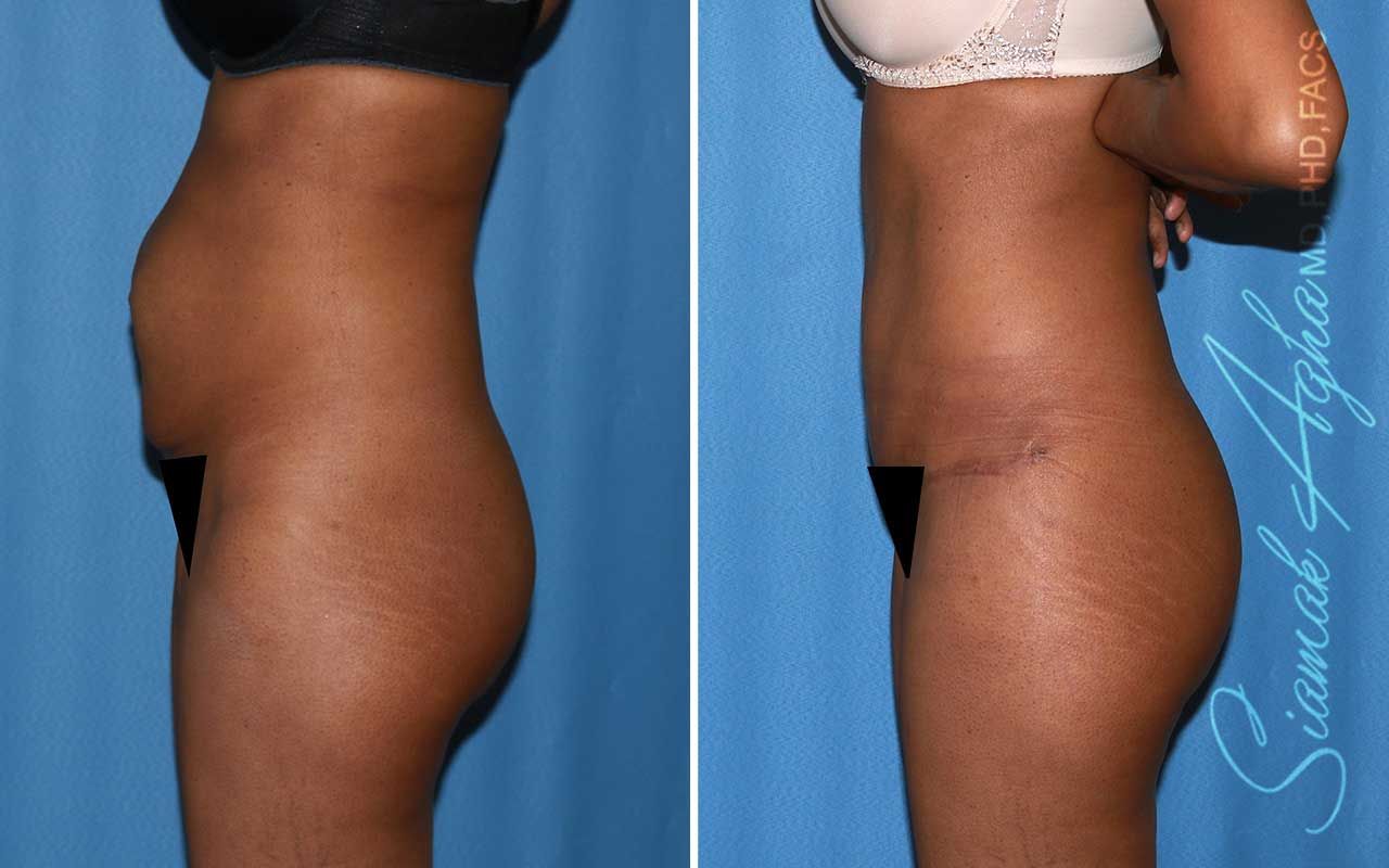 Tummy Tuck Before & After