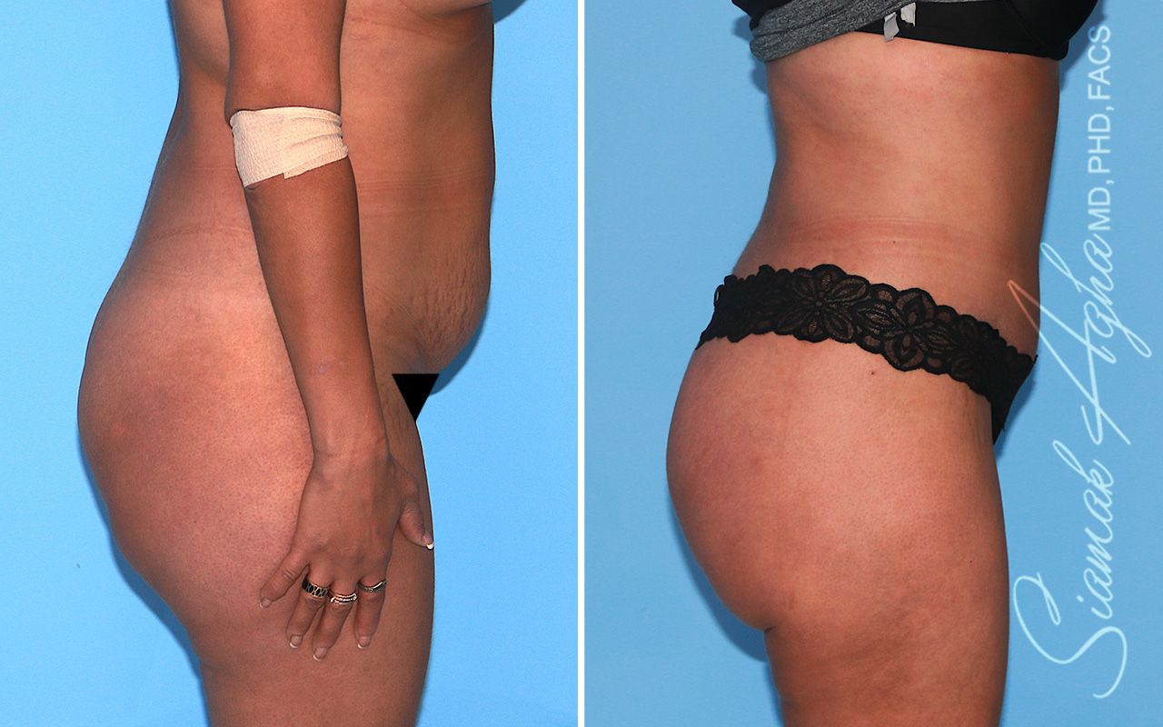 Tummy Tuck Before & After