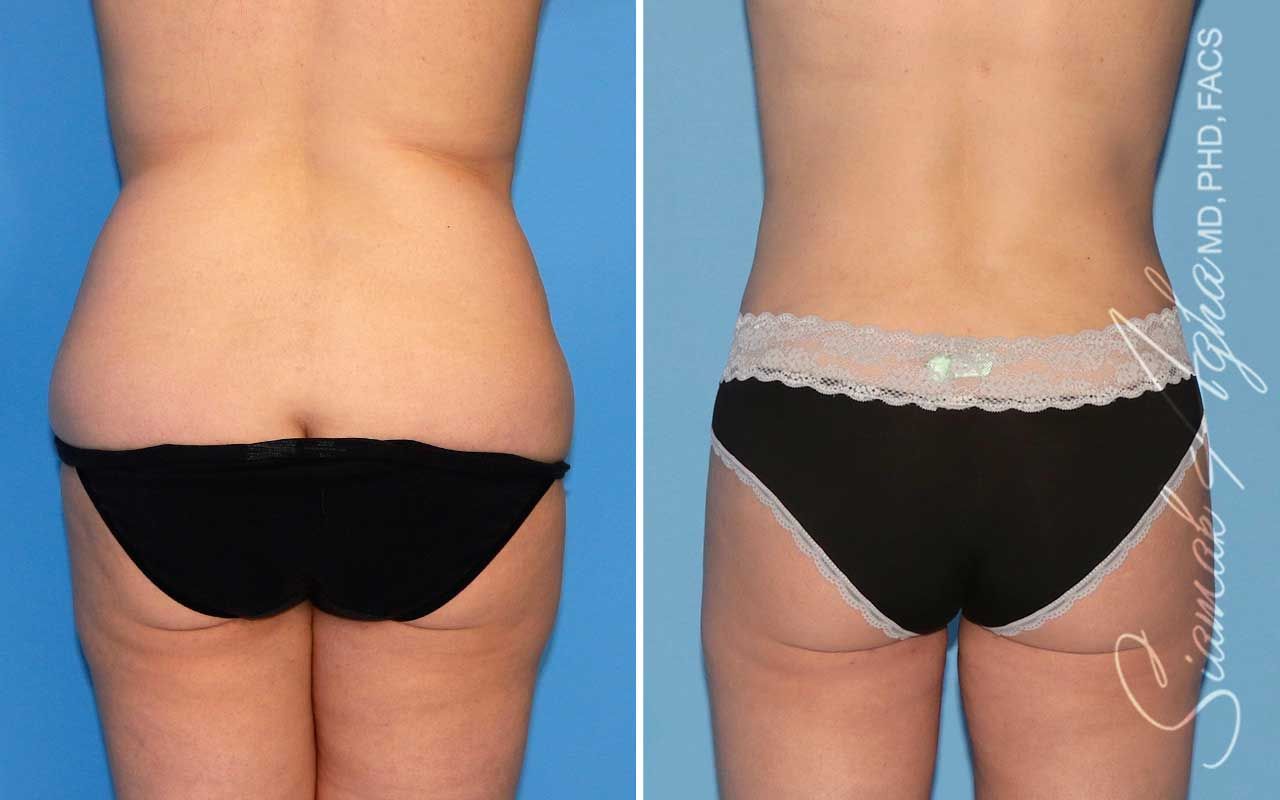 Tummy Tuck Before & After
