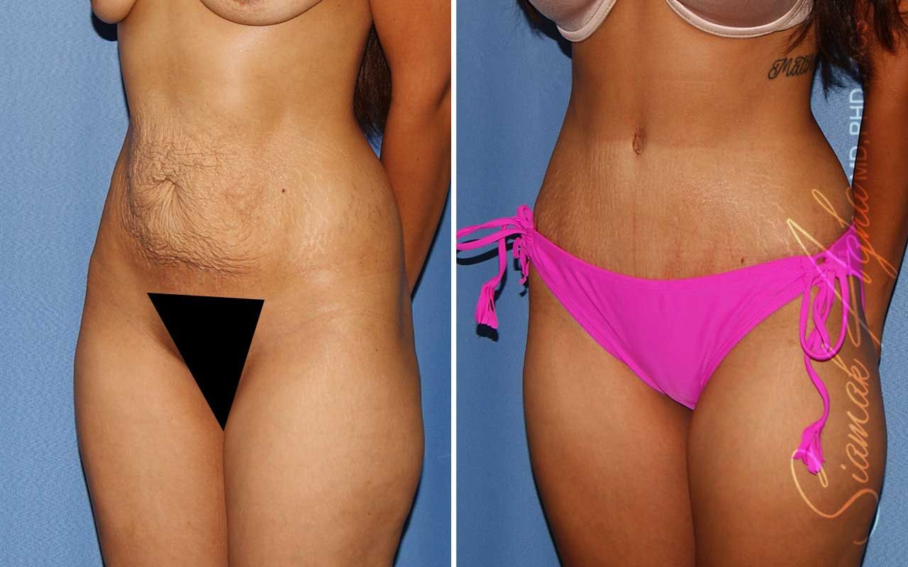 Tummy Tuck Before & After