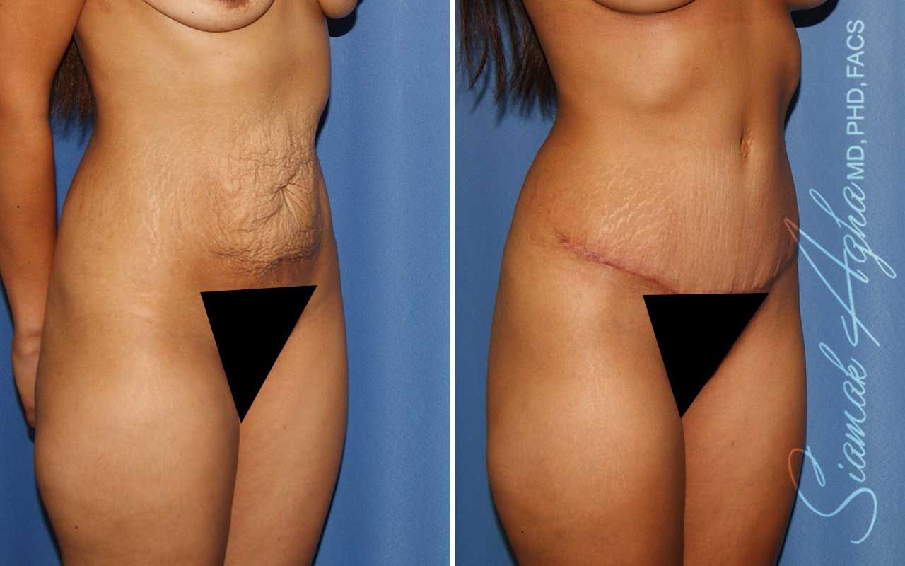 Tummy Tuck Before & After