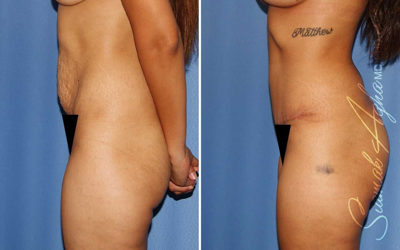 Tummy Tuck Before & After