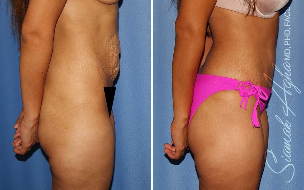 Tummy Tuck Before & After