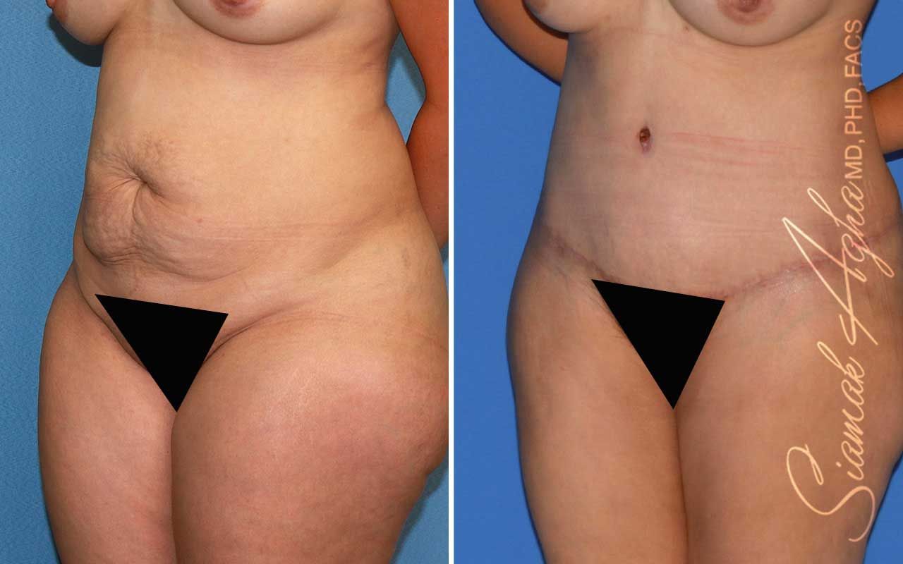 Tummy Tuck Before & After