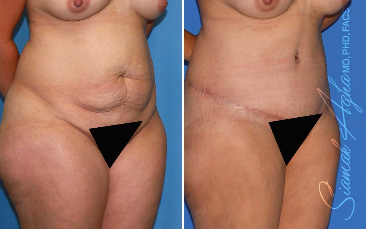 Tummy Tuck Before & After