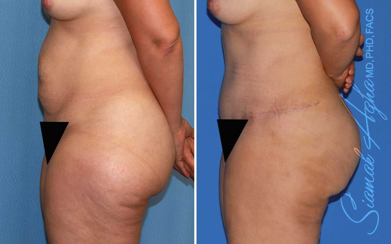 Tummy Tuck Before & After