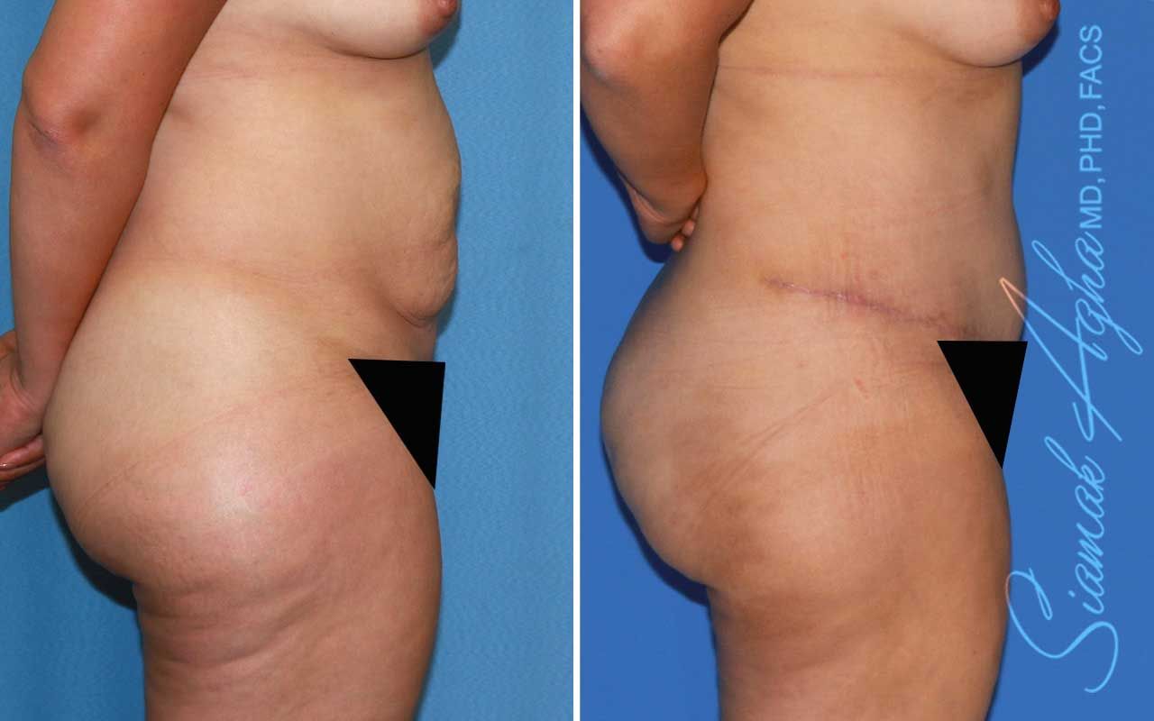Tummy Tuck Before & After