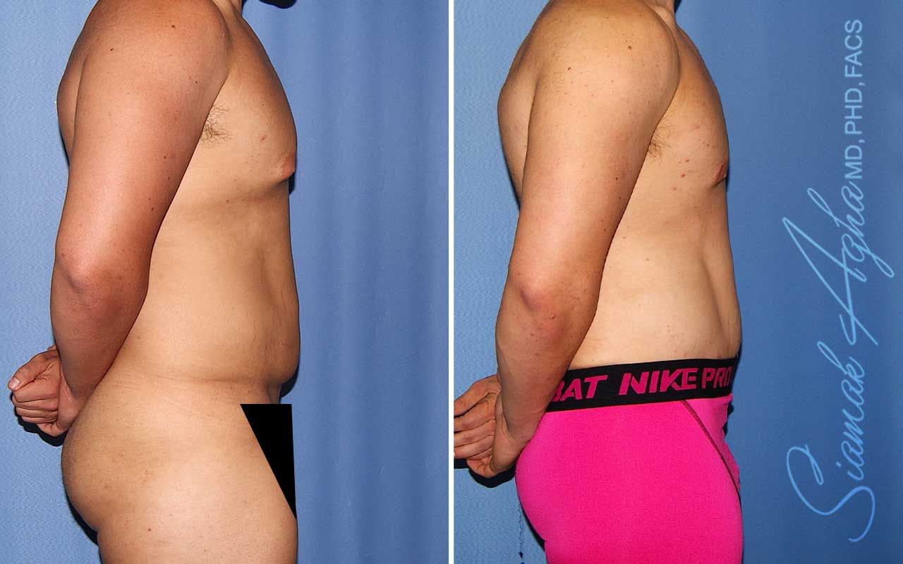 Tummy Tuck Before & After