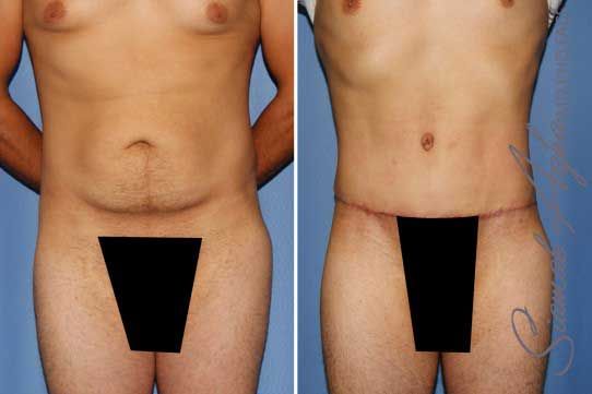 Tummy Tuck Before & After