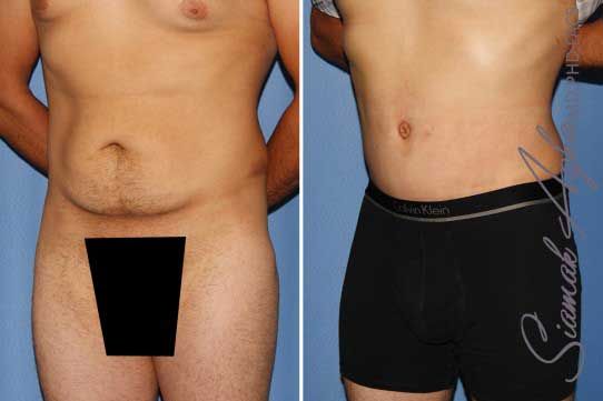 Tummy Tuck Before & After