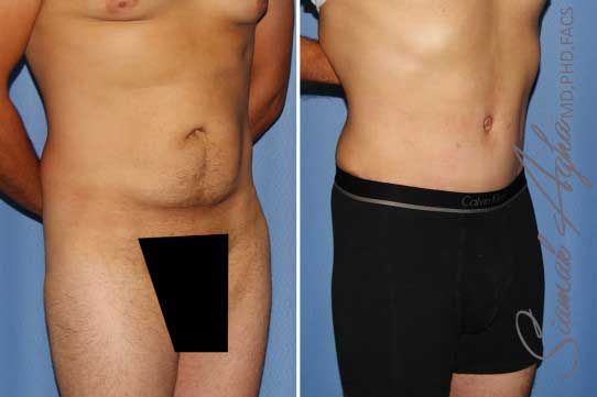 Tummy Tuck Before & After