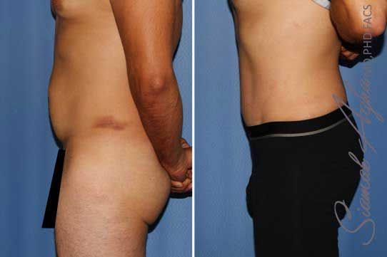 Tummy Tuck Before & After