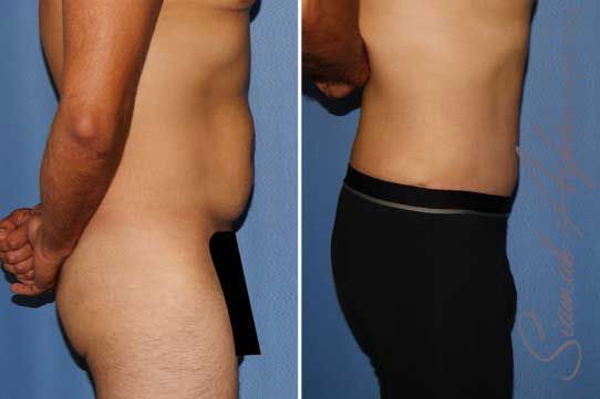 Tummy Tuck Before & After