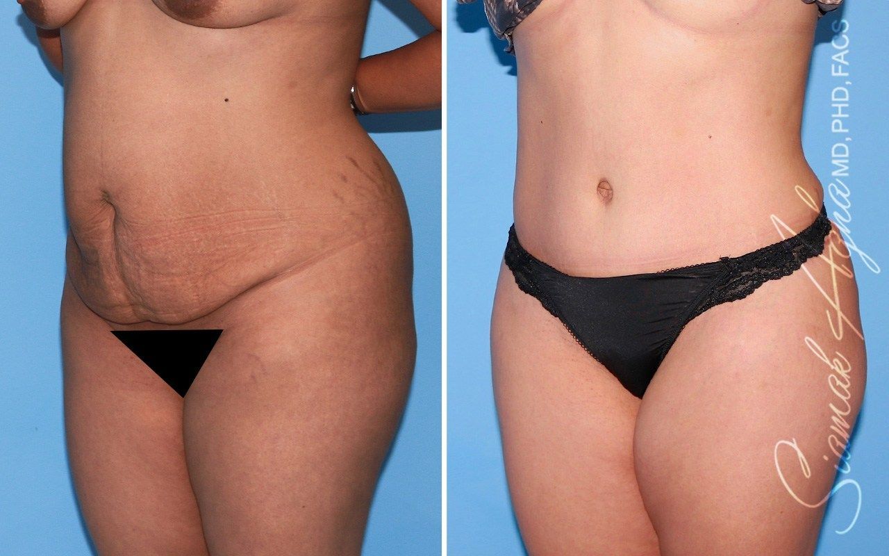 Tummy Tuck Before & After