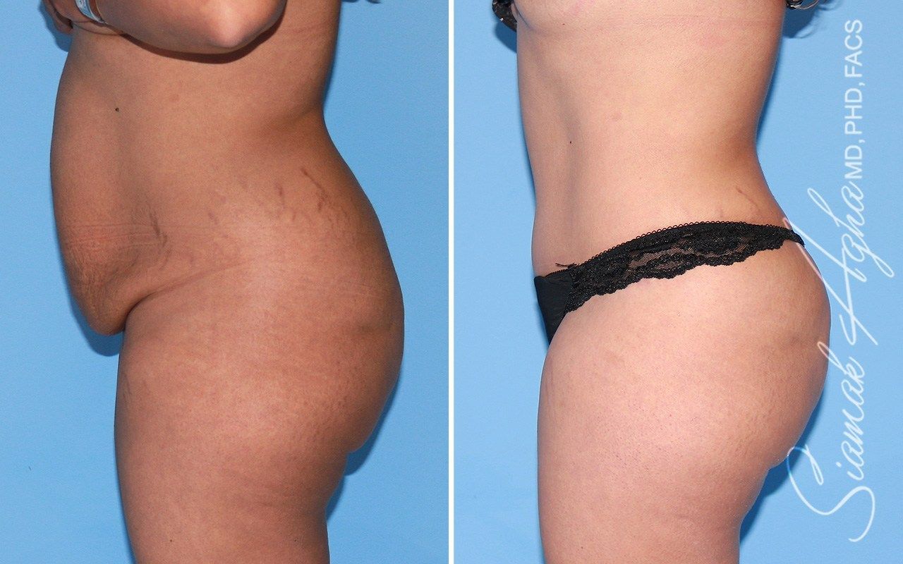 Tummy Tuck Before & After