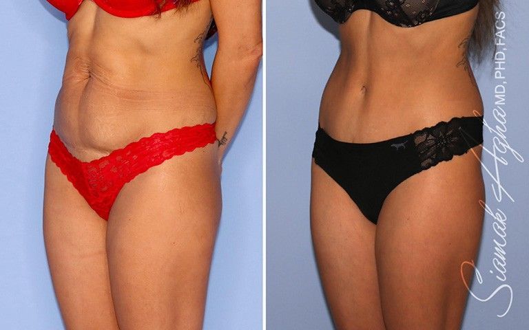 Tummy Tuck Before & After