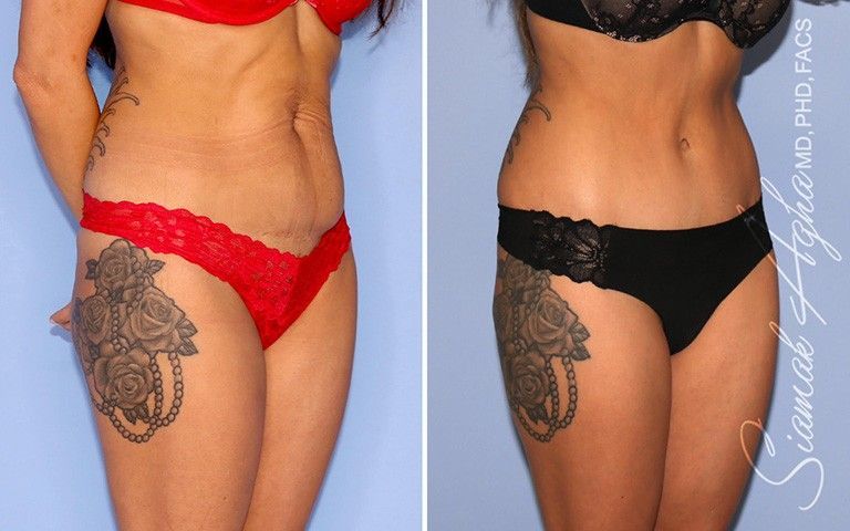 Tummy Tuck Before & After