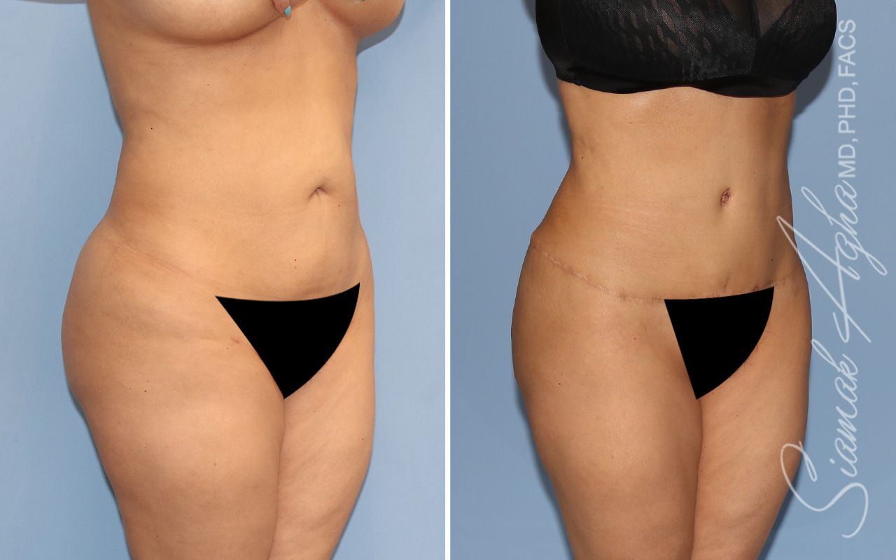 Tummy Tuck Before & After