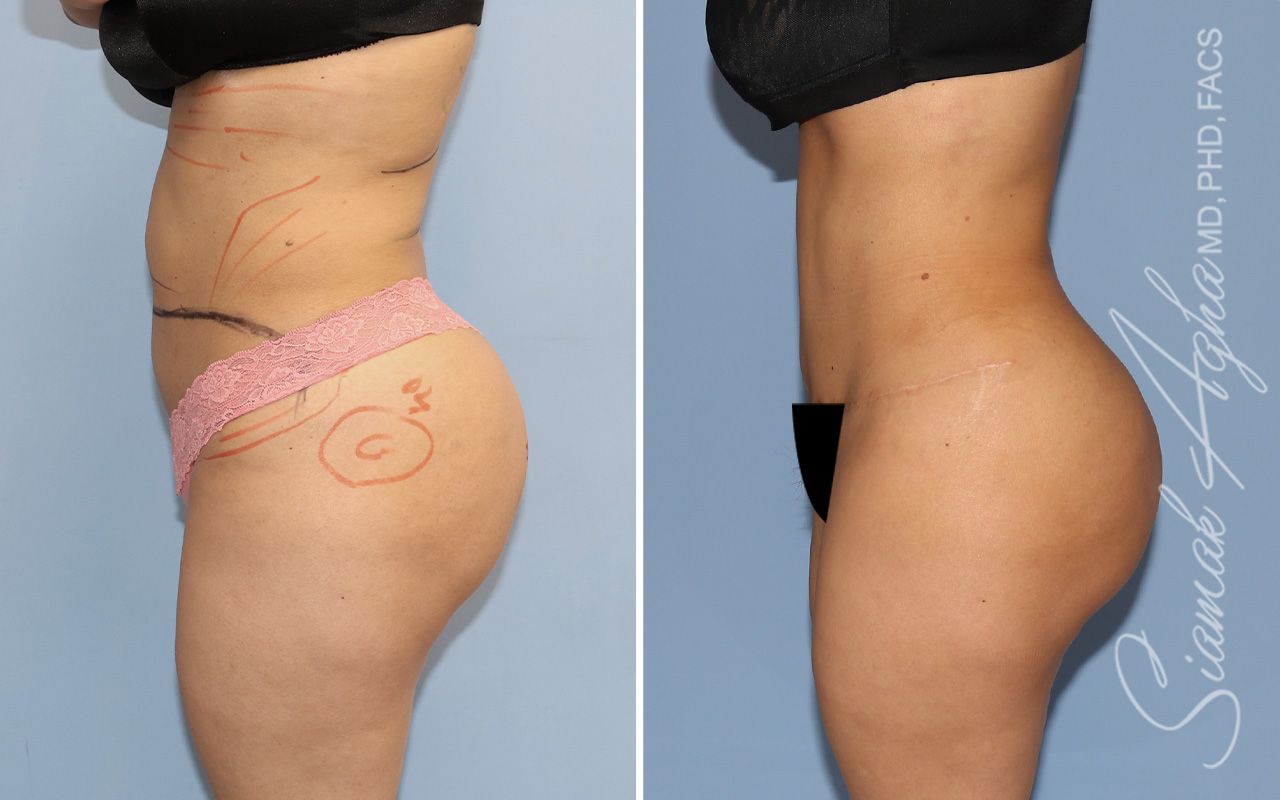 Tummy Tuck Before & After
