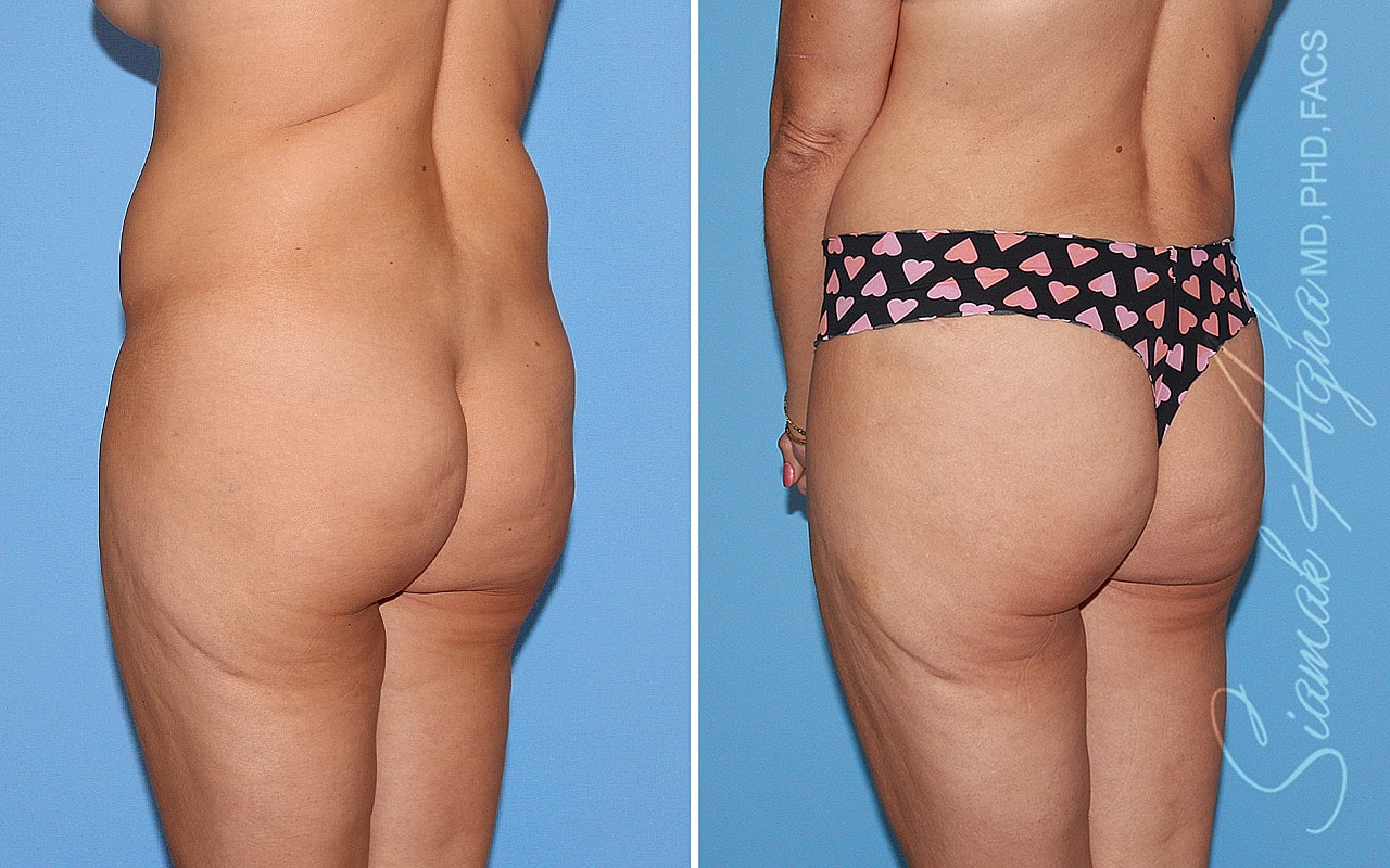 Tummy Tuck Before & After