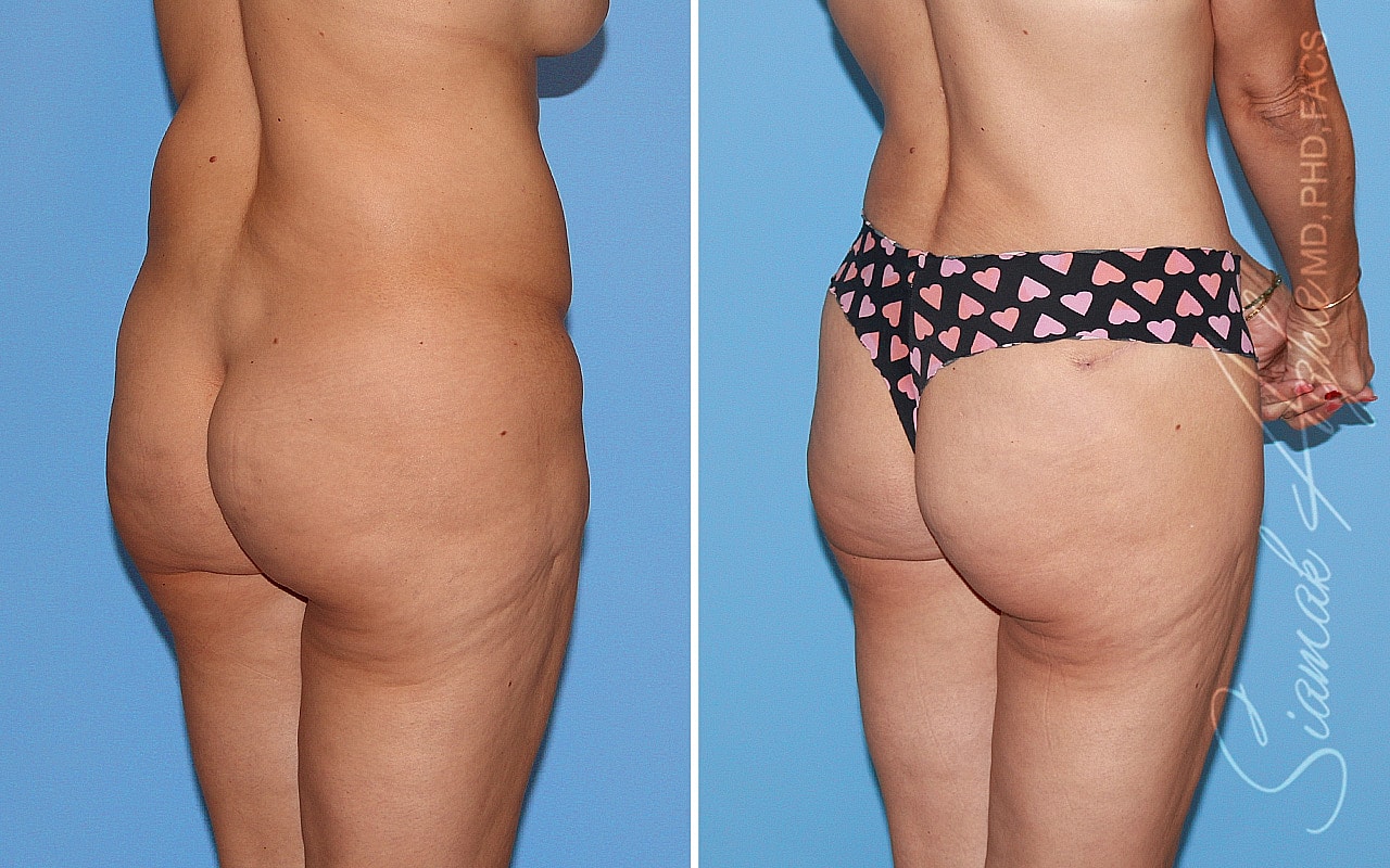 Tummy Tuck Before & After