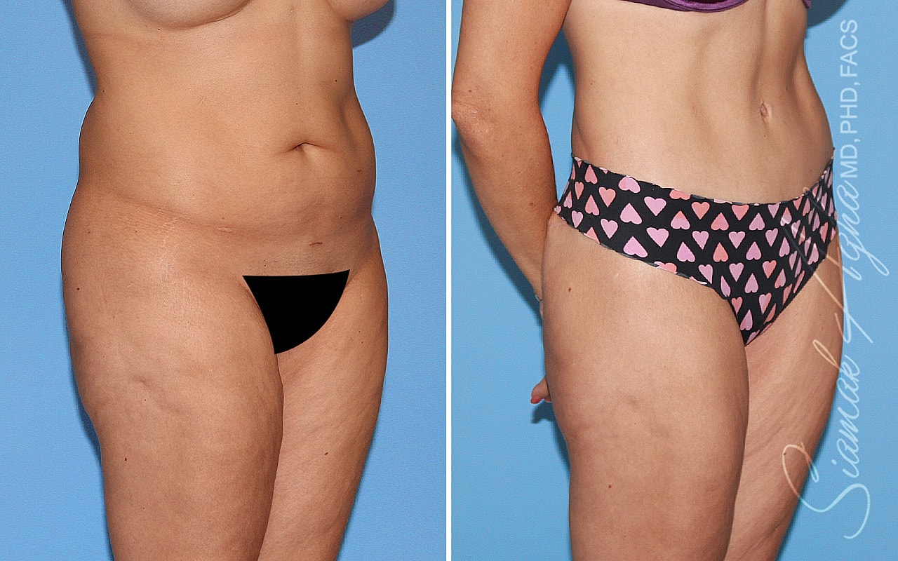 Tummy Tuck Before & After