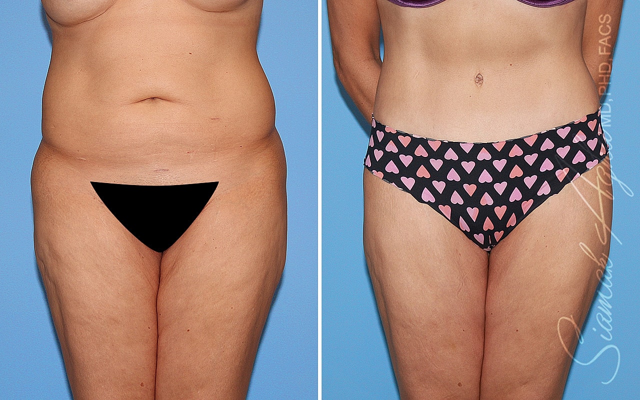 Tummy Tuck Before & After