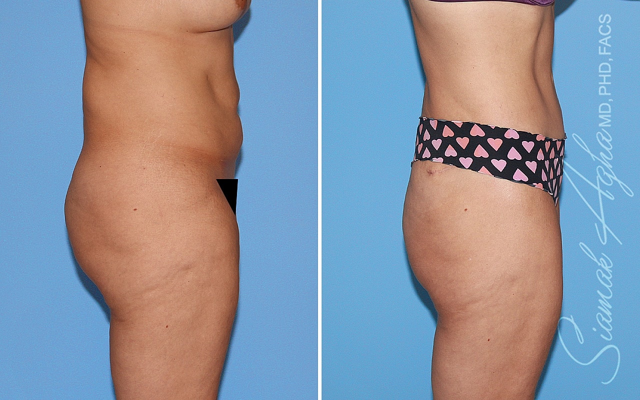 Tummy Tuck Before & After