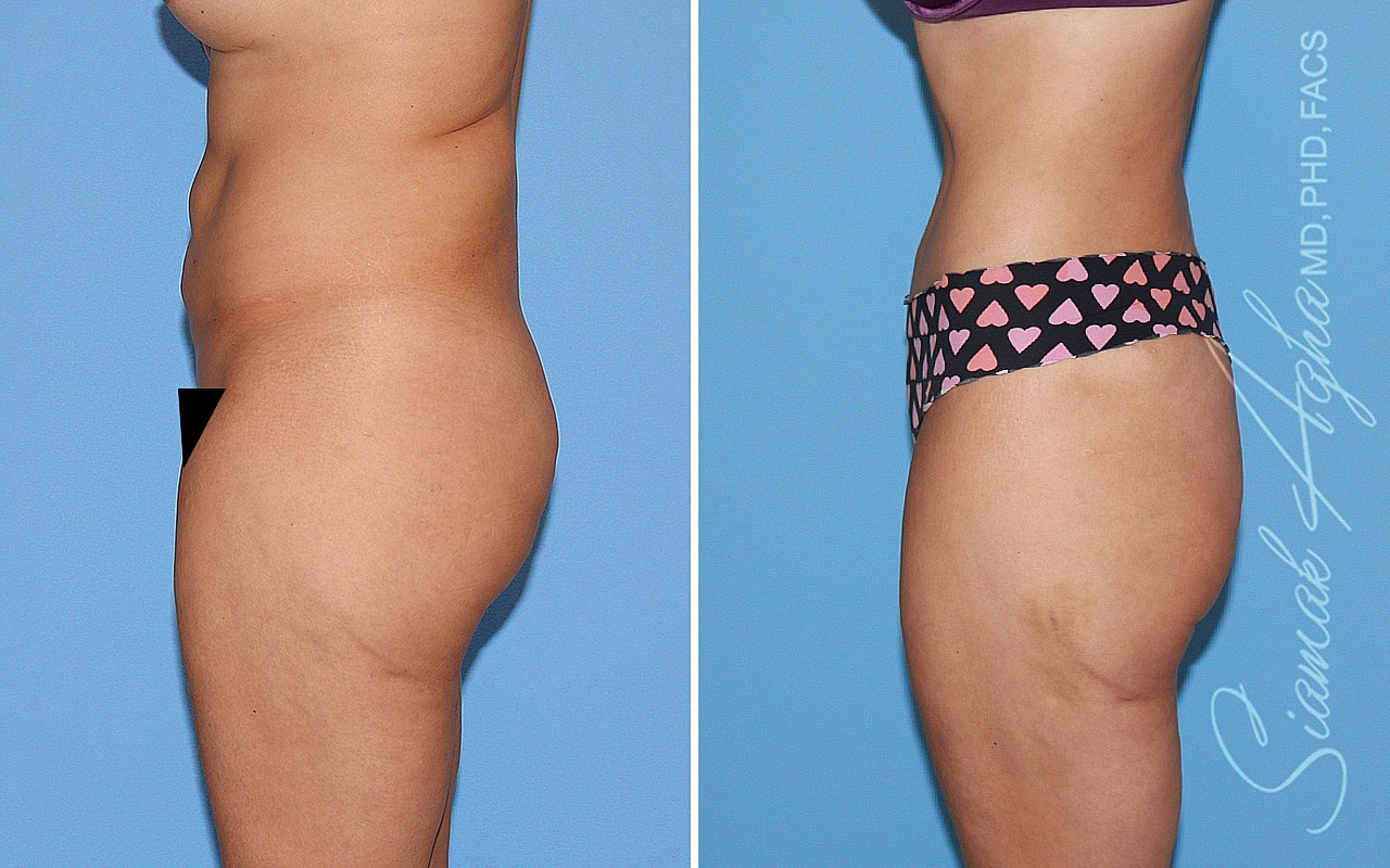 Tummy Tuck Before & After