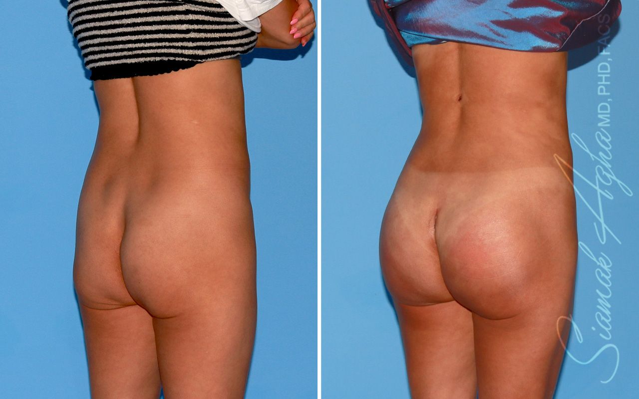 Buttock Implants Before & After