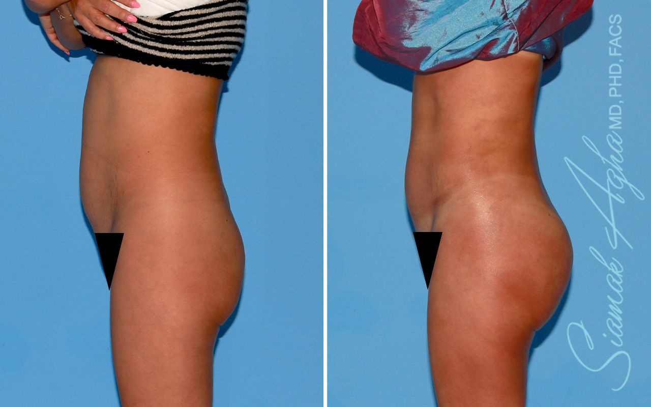 Buttock Implants Before & After