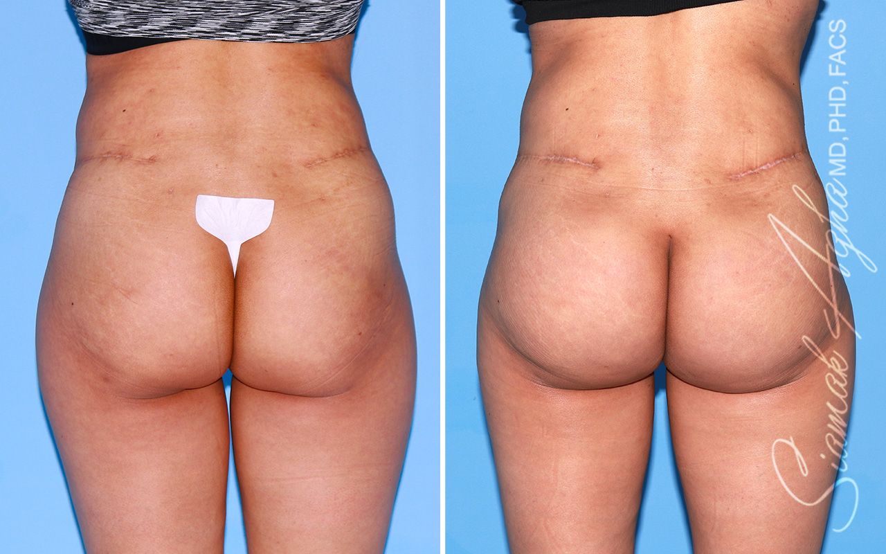 Buttock Implants Before & After