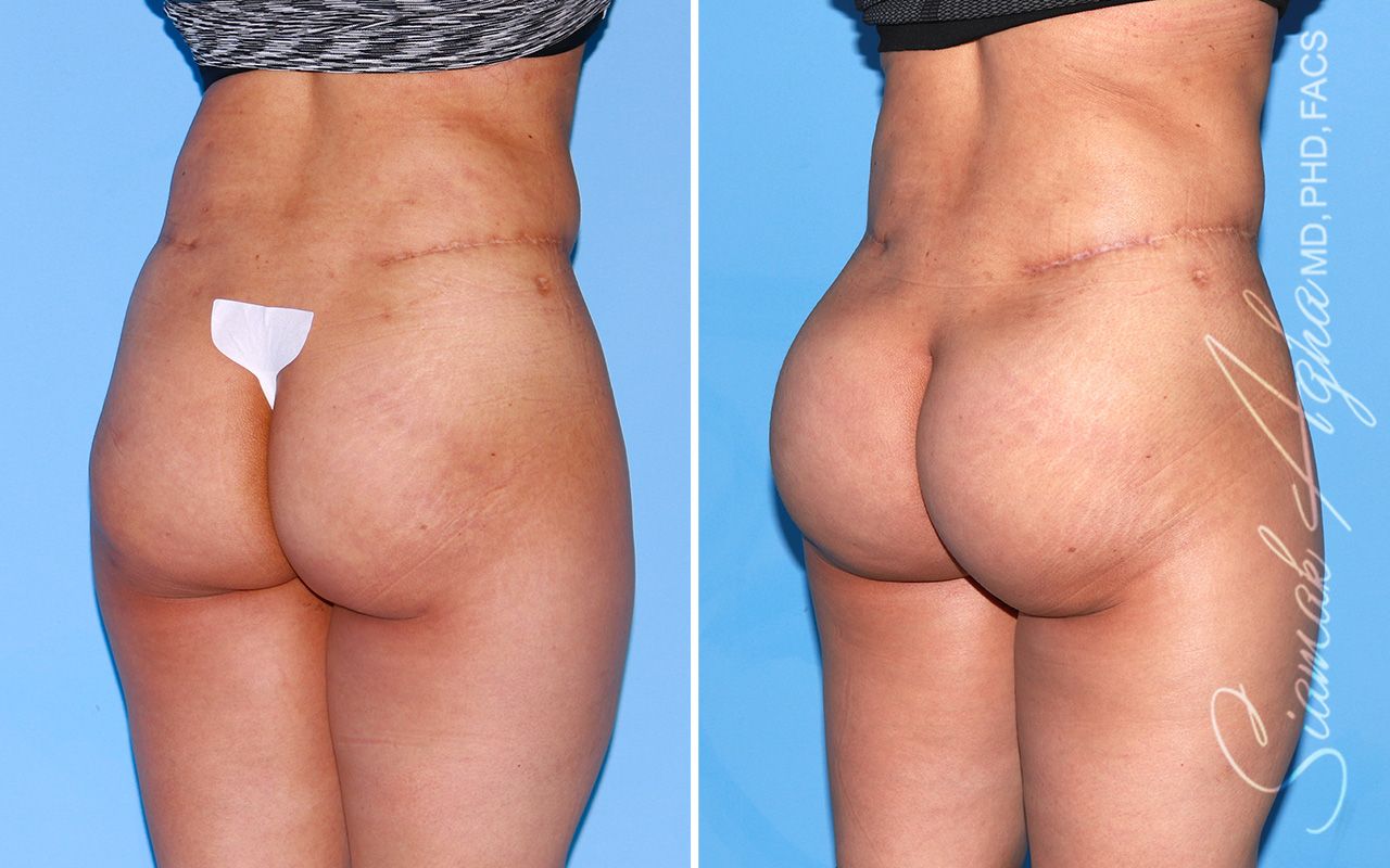 Buttock Implants Before & After