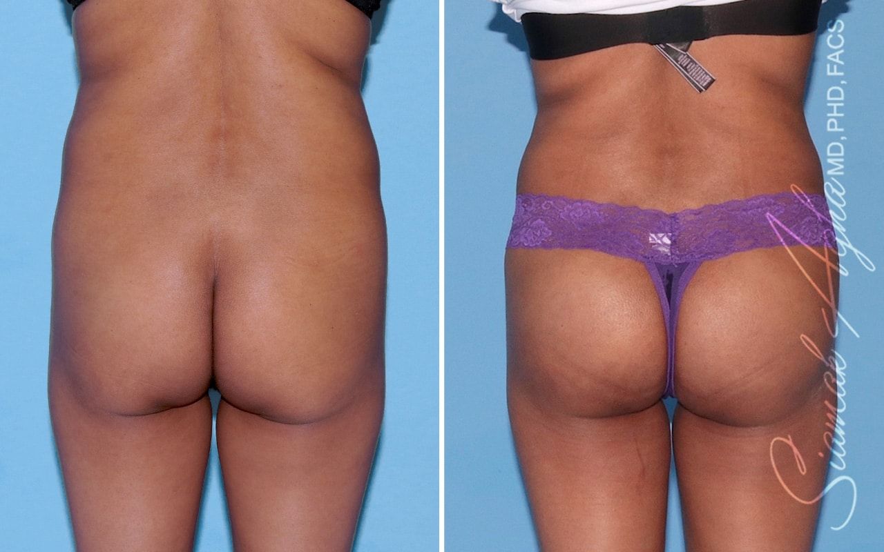 Buttock Implants Before & After