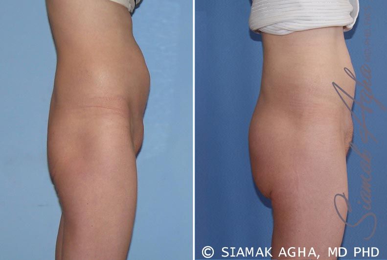 Buttock Implants Before & After