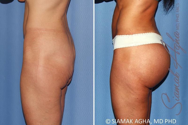 Buttock Implants Before & After