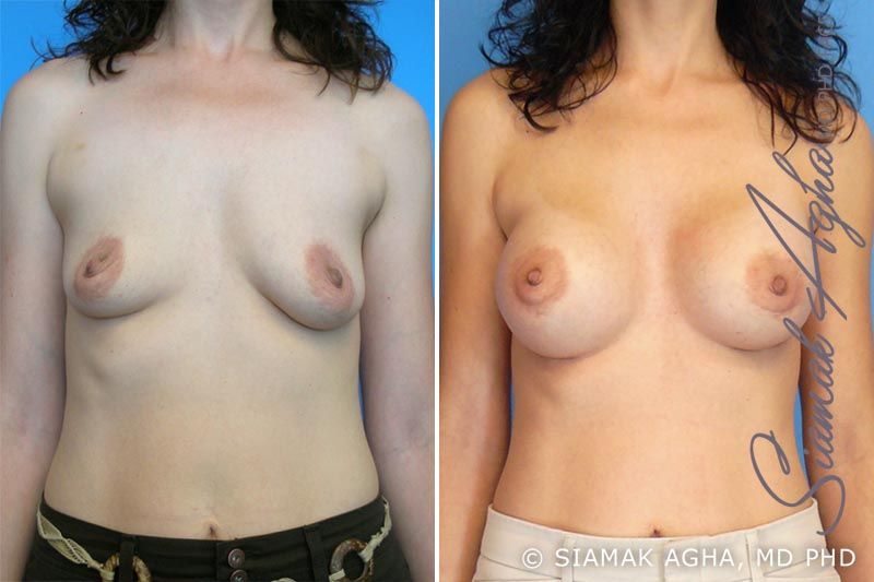 Breast Augmentation Before & After