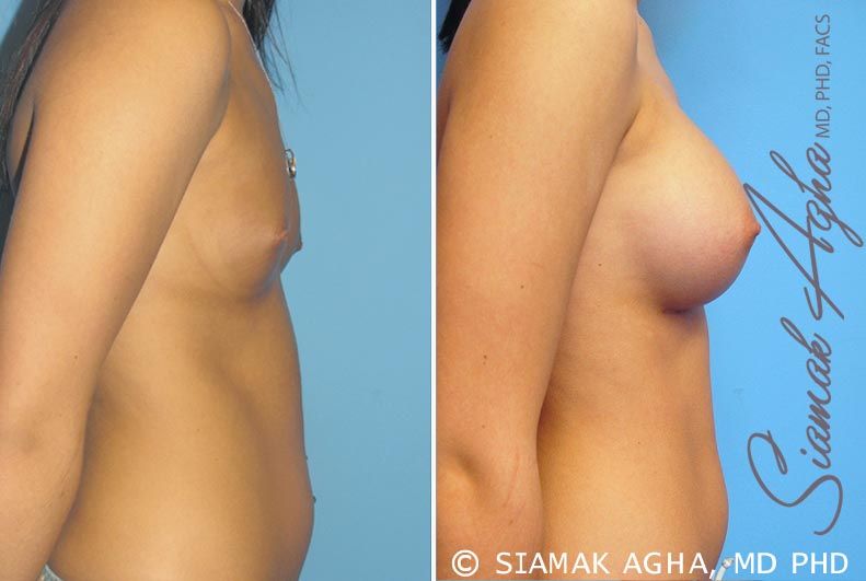 Breast Augmentation Before & After