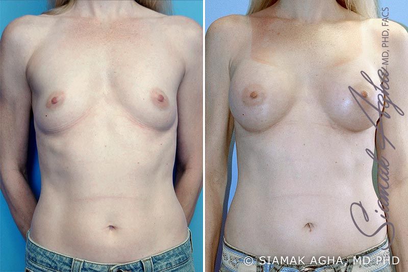 Breast Augmentation Before & After