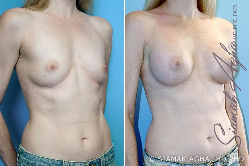 Breast Augmentation Before & After