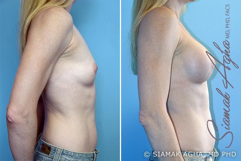 Breast Augmentation Before & After