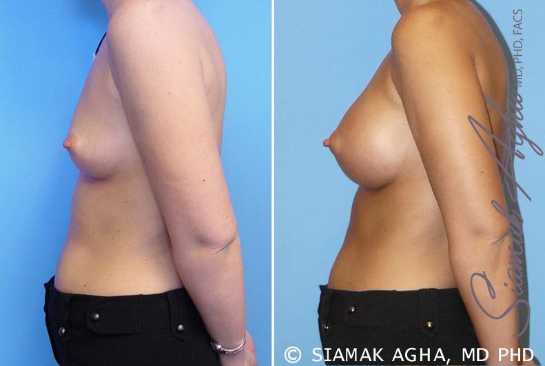 Breast Augmentation Before & After