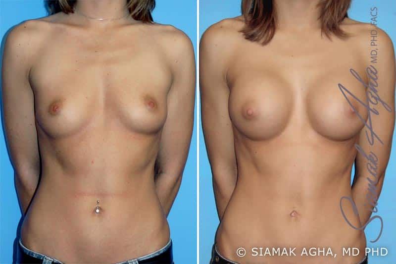 Breast Augmentation Before & After