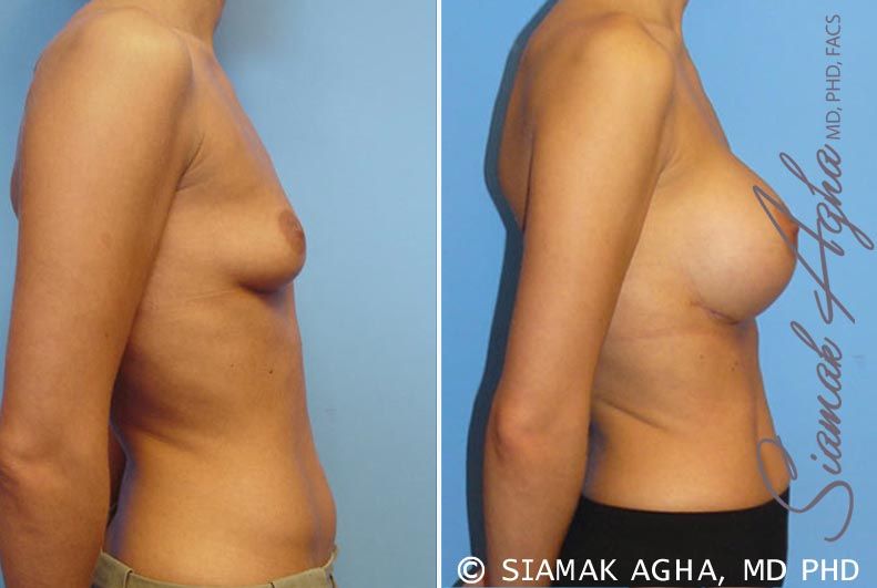 Breast Augmentation Before & After