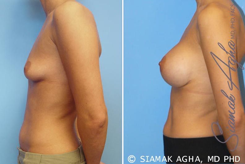 Breast Augmentation Before & After