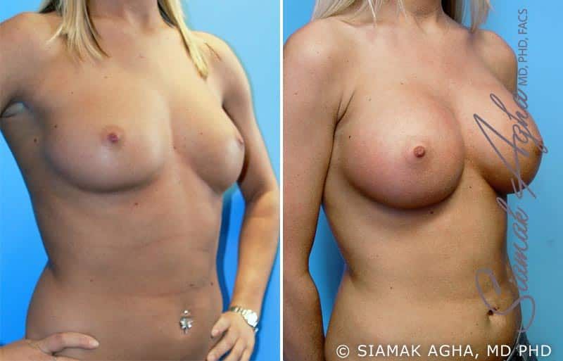 Breast Augmentation Before & After