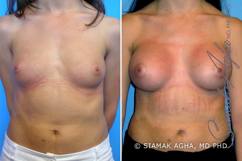 Breast Augmentation Before & After
