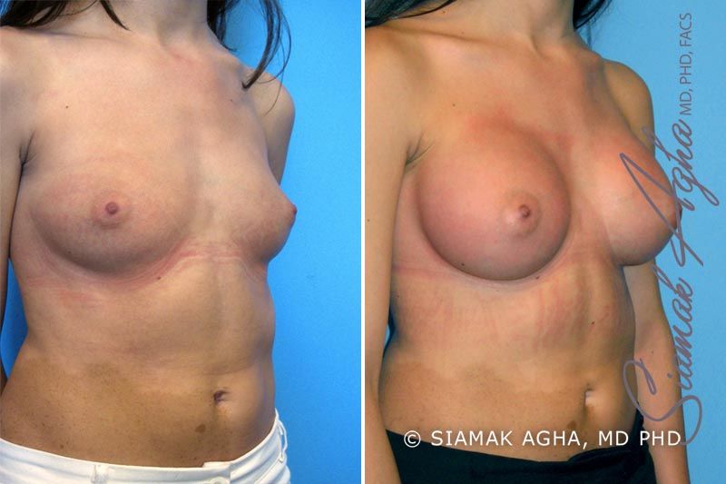 Breast Augmentation Before & After