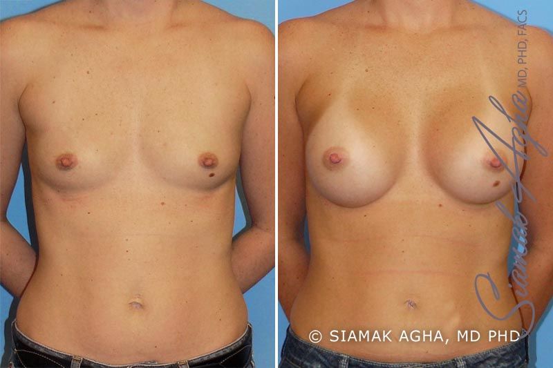 Breast Augmentation Before & After