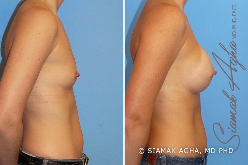 Breast Augmentation Before & After